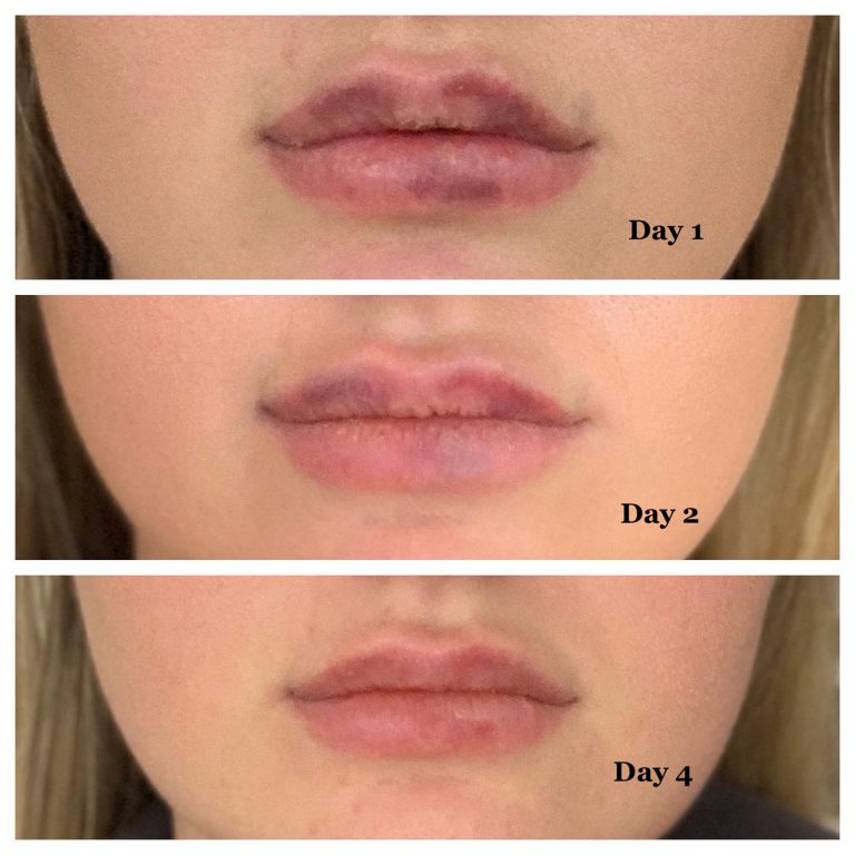 <p>My lip injector Melanie give me a MedX lip gloss after my procedure and I absolutely loved it. My bruises healed faster and my lips felt really hydrated. I still use MedX even without getting my lips filled. 10/10</p>